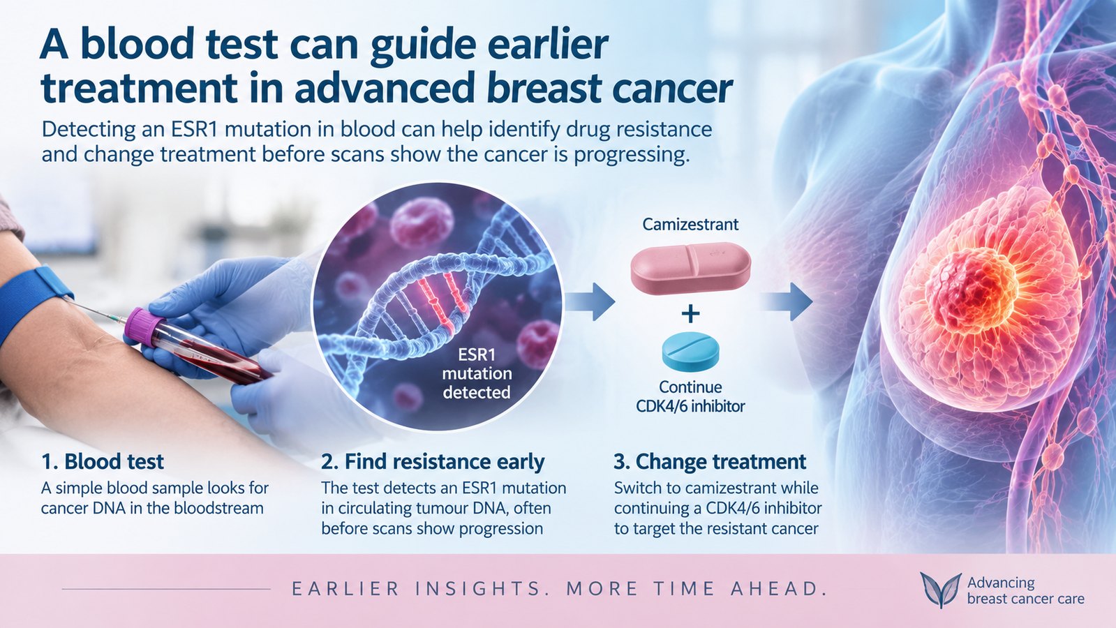 Conceptual medical illustration showing blood test detection of ESR1 mutation and earlier camizestrant treatment change in advanced breast cancer