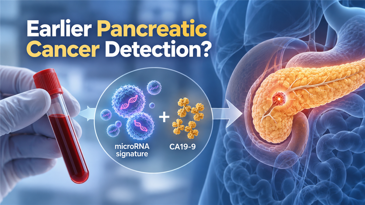 Medical illustration showing a blood-based microRNA and CA19-9 biomarker approach being studied for detection of small early-stage pancreatic cancers.