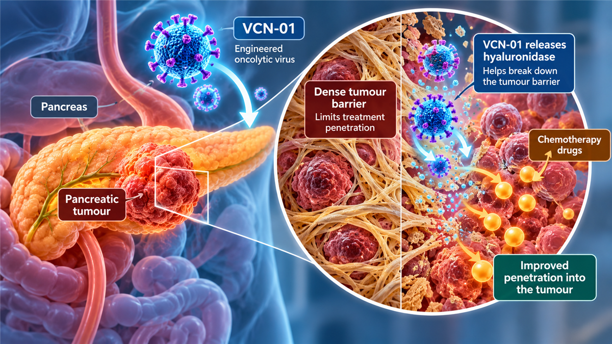 Medical illustration of VCN-01 breaking down the tumour barrier in metastatic pancreatic cancer